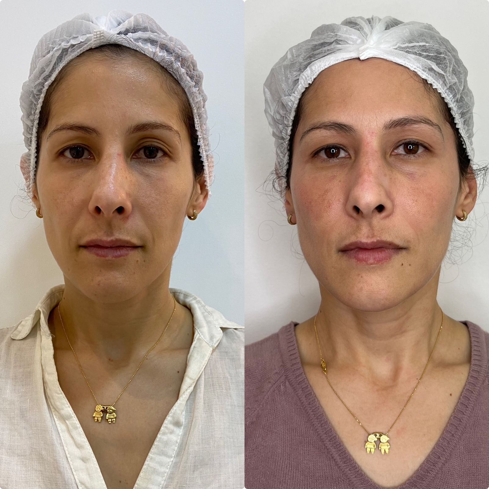 Lifting Facial